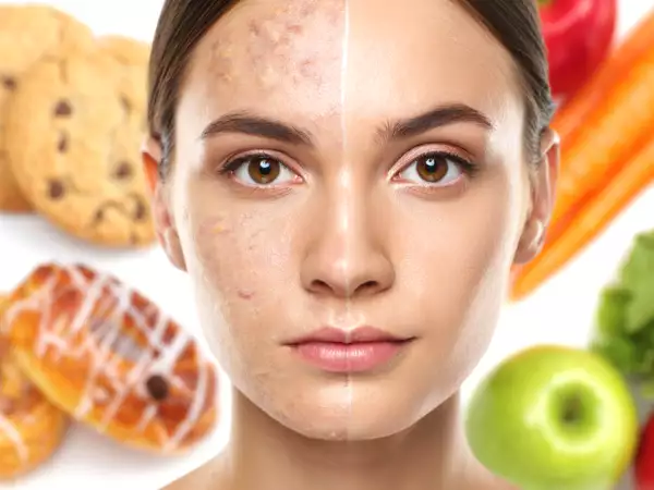 If you eat them often, you risk pimples and dull skin: here are the guilty foods